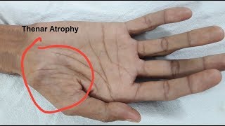 Thenar Atrophy in Motor Neuron Disease [upl. by Allain88]