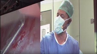 Live Surgery  Bladder Tumour Resection [upl. by Ednalrim]