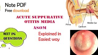 Acute Suppurative Otitis Media  ASOM  ENT  Easy explanation  Stages  Diagnosis  Management [upl. by Matheson]