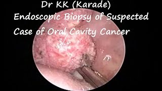 Endoscopic Biopsy of Suspected Case of Oral Cavity Cancer Under LA  SCC [upl. by Yramesor]