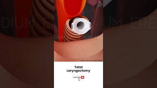 Laryngectomy Throat Cancer Surgery ↪ 3D Medical Animation Shorts Laryngectomy Throat Surgery [upl. by Greene]