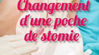 Définition et changement dune poche de colostomie [upl. by Atirak]