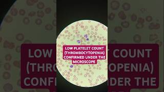 Thrombocytopenia low platelet confirmed under the microscope thrombocytopenia plateletcount [upl. by Catherine759]