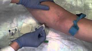 Phlebotomy on Live Patient Straight Needle [upl. by Ayenat835]