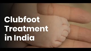 Clubfoot Treatment in India  Clubfoot Treatment Cost in India [upl. by Airbmac]