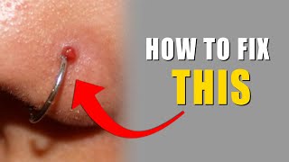 How I Removed My Nose Piercing Bump keloid  SAMADHAN [upl. by Arlie374]