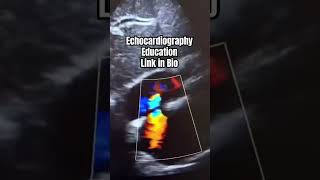 Patent foramen ovale echocardiography [upl. by Joete776]