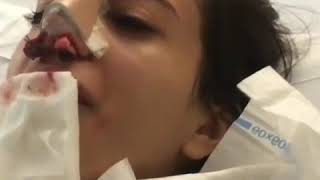 Removal of nondissolving nasal packs after Elite Surgical Rhinoplasty Nosejob by Dr Sultan Hassan [upl. by Publea]