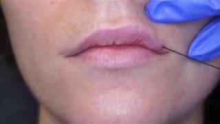 FDA Approved  Restylane Silk via MicroCannula in the lips [upl. by Lepley11]