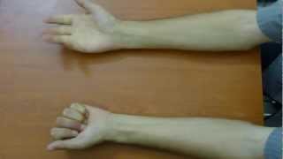 wwwdrbasimshamancom  synkinesis mirror movements  examination orthopaedics neorology [upl. by Alduino]