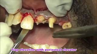 Failed root canal treated teeth with Periapical Pathology [upl. by Britni]