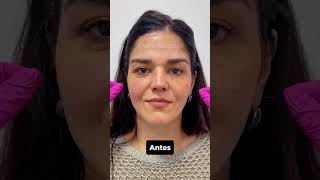 RESULTADO DE BOTOX  BIORECONEXÃO rejuvenescimentofacial hof esteticaregenerativa botox [upl. by Ahcsas950]