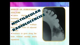 MULTILOCULAR RADIOLUCENCIES OF THE JAW [upl. by Merkle]