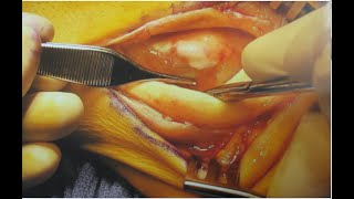 Ankle Injury 2C Peroneal Tendon Repair with Images [upl. by Carli]