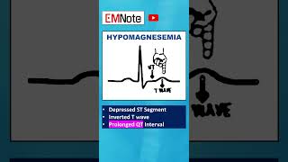 Electrolytes ECG Changes medical doctor nursing [upl. by Markson]