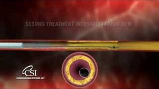 Orbital Atherectomy at Penn Presbyterian Lee Kirksey MD [upl. by Mou]