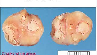 Chronic Lymphadenitis gross and microscopic features for medical students [upl. by Ario900]