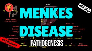 MENKES DISEASE Pathogenesis Clinical symptoms Treatment for USMLE [upl. by Ahsinna]