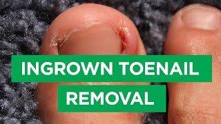 Ep 59 Ingrown Toenail Removal Procedure  The Scope [upl. by Mclaughlin641]