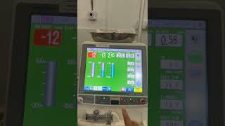 Venous pressure alarm in NiKkISO machine hemodialysis ckdpatient [upl. by Cloe54]