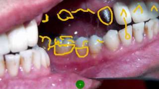 Edident Lab quotDental Upper six unit Porcelain Buildup Part 1quot [upl. by Deloria729]