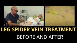 LEG SPIDER VEIN TREATMENT  BEFORE AND AFTER [upl. by Sirrep]