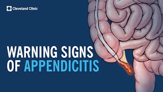 Warning Signs of Appendicitis [upl. by Ellerrad829]