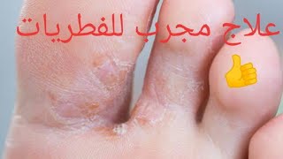 العلاج الفعال لفطريات القدم la mycose du pied [upl. by Sidhu230]