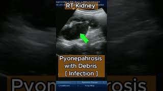 Renal Infection  Pyonephrosis [upl. by Mccollum557]