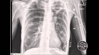 Xray Interpretation  Cavitary Lesions [upl. by Eihpos]