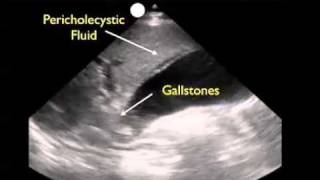 How To Gallbladder Ultrasound Part 3  Acute Cholecystitis Case Study Video [upl. by Alidis384]