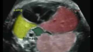 Fetal Medicine Foundation  Congenital diaphragmatic hernia [upl. by Nafets]