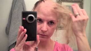 Road to balddom Last 5 days of Chemo hair loss Process [upl. by Notsirhc976]