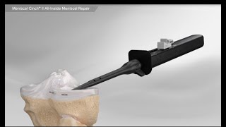 Meniscal Cinch™ II AllInside Meniscal Repair [upl. by Eerdua]