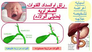 Biliary Atresia  انسداد القنوات المراريه في حديثي الولاده الأسبابالأعراضالعلاج [upl. by Barney]