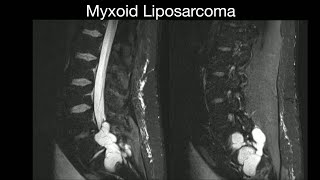 Myxoid Liposarcoma [upl. by Laertnom]