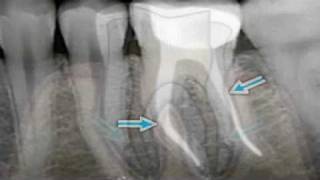 What is Endodontics [upl. by Tilney868]