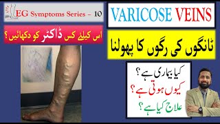 Varicose Veins ٹانگوں کی رگوں کا پھولنا ْ UrduHindi Dr Ali Hassan [upl. by Dnomar707]