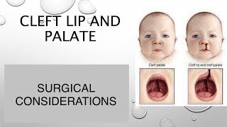 CLEFT LIP PALATESURGICAL CONSIDERATIONS dentabest4493 [upl. by Columbyne]