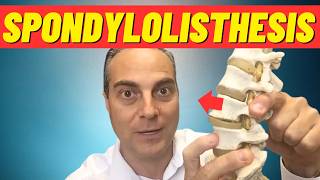 What Is Spondylolisthesis What Is Anterolisthesis Dr Walter Salubro Chiropractor in Vaughan [upl. by Zul25]