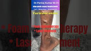 Varicose veins treatment for SSC GD medical Best varicose veins treatment shorts varicoseveins [upl. by Tamaru469]