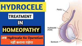 Hydrocele Treatment  Home Remedies For Hydrocele  Dr Saad Ahmed [upl. by Aerdma73]