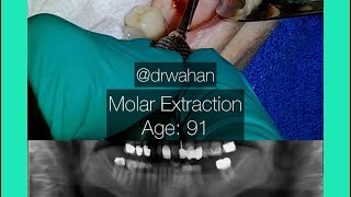 Molar Extraction with Cowhorn Forceps Age 91 [upl. by Lezah102]