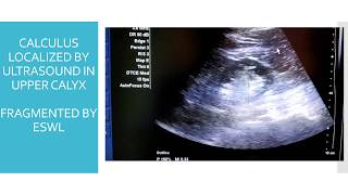 ULTRASOUND GUIDED ESWL FOR RENAL CALCULI [upl. by Ignazio]