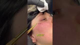 Did you know how the dermal removal is done 🤓 Subscribe piercing piercings removal shorts [upl. by Byrd610]