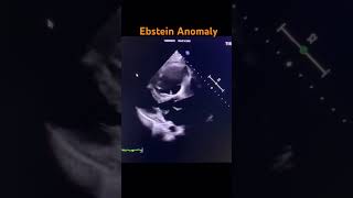 Ebstein anomaly 2 D echo cardiology clinical heart [upl. by Talmud]