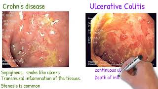 Crohns disease vs Ulcerative Colitis made simply [upl. by Monika]