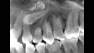 Canines incluses CBCT scan impacted cuspids orthodontie 123213 IT31 [upl. by Landahl]