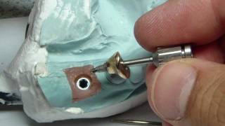 AhhStripped Implant Abutment Screw [upl. by Wachtel434]