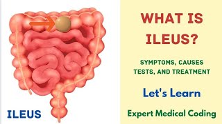 What is Ileus  Symptoms  Causes  Complications  Tests  Treatment Precautions Medical Coding [upl. by Nnitsuj]